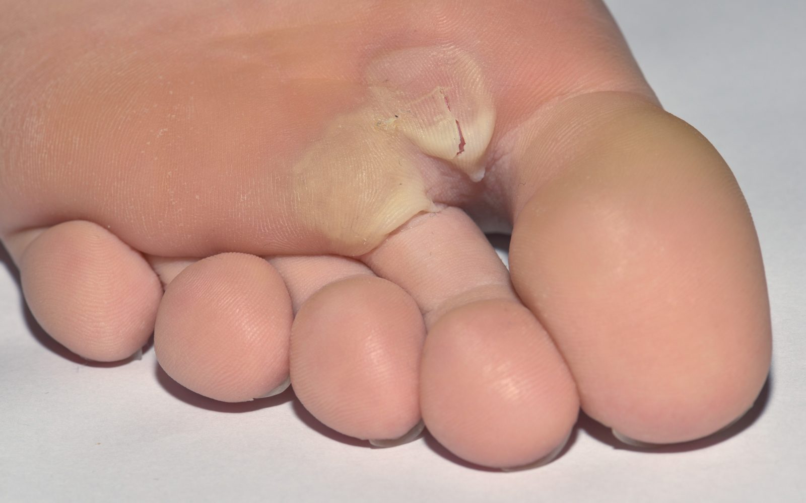 Počen mehur na stopalu, nastal kot posledica zaradi neustrezne obutve.