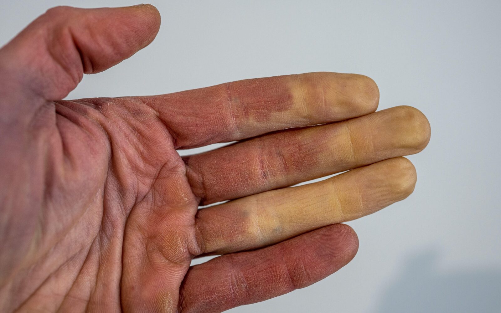 Roka z belimi prsti - Raynaudov sindrom