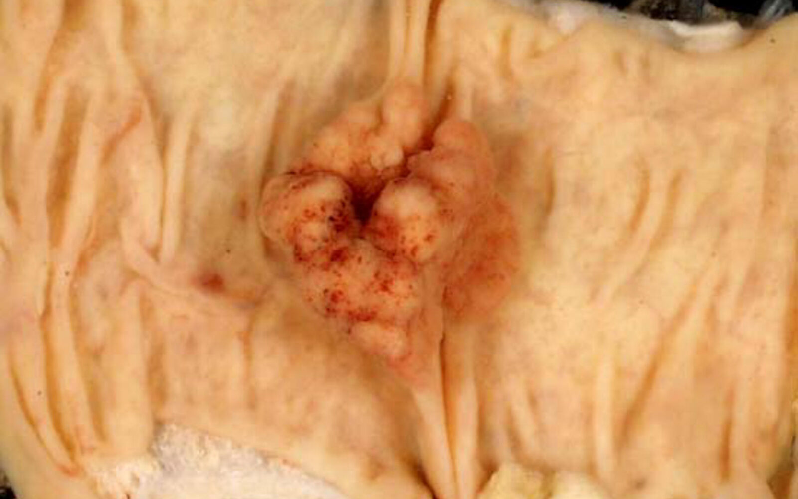 Polip debelega črevesa