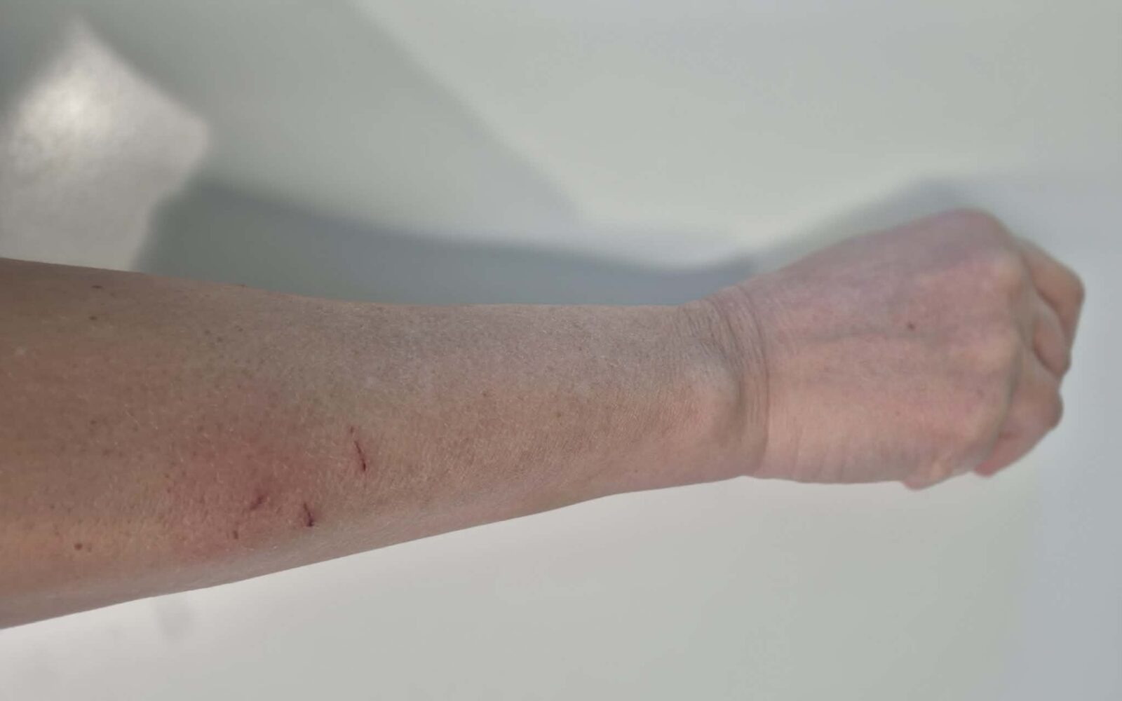 Mačji ugriz na roki z manjšimi vbodnimi ranami