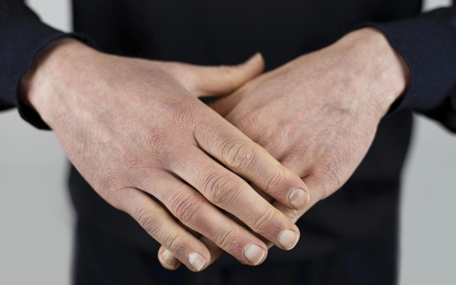 Prvi znaki ozeblin se pogosto pokažejo na rokah, kjer je koža najpogosteje izpostavljena mrazu.