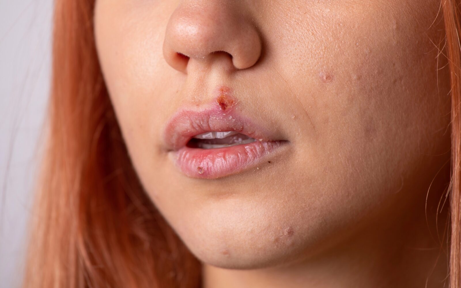 bližnji posnetek ženskega obraza z labialnim hepesom