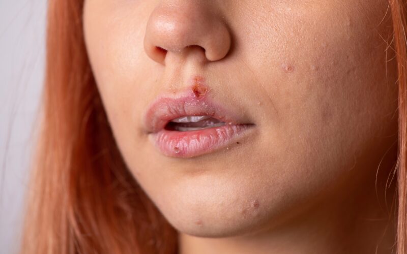 bližnji posnetek ženskega obraza z labialnim hepesom