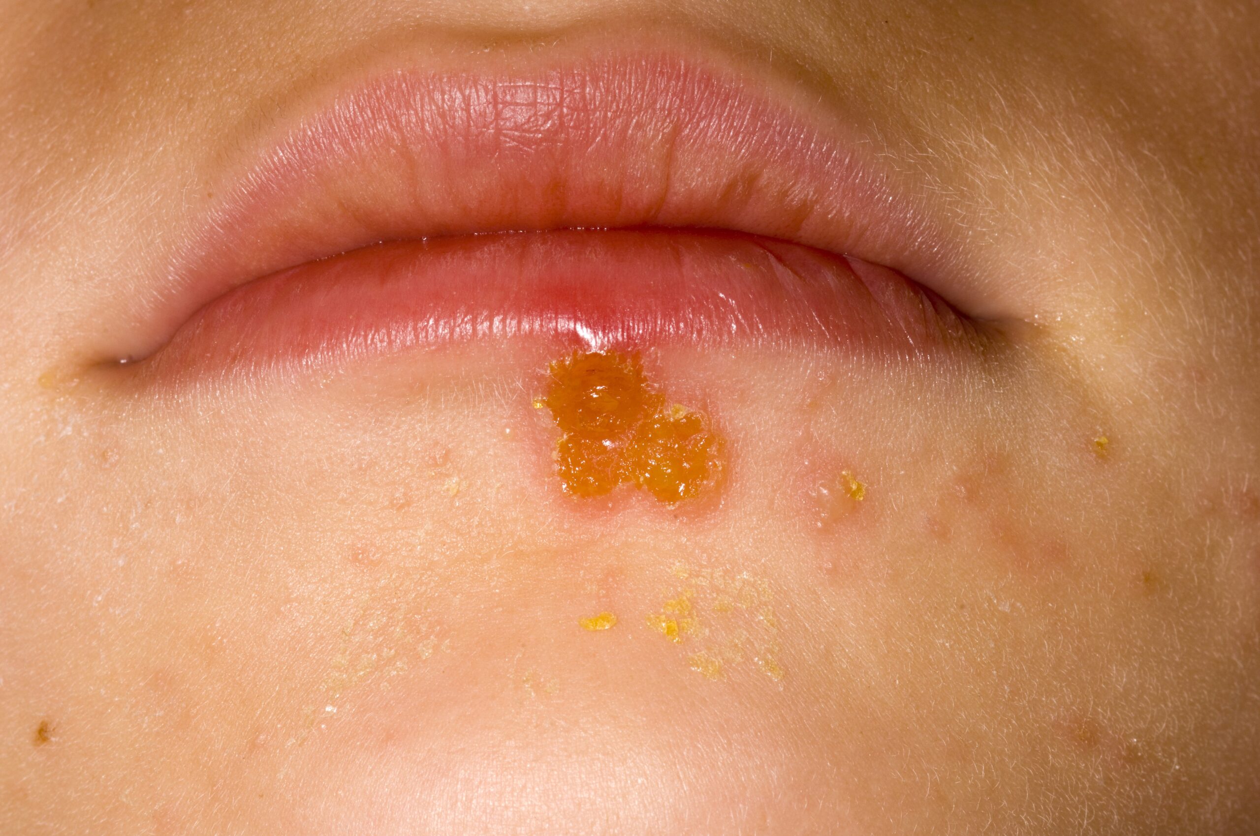 impetigo kraste medene barve pod ustnico