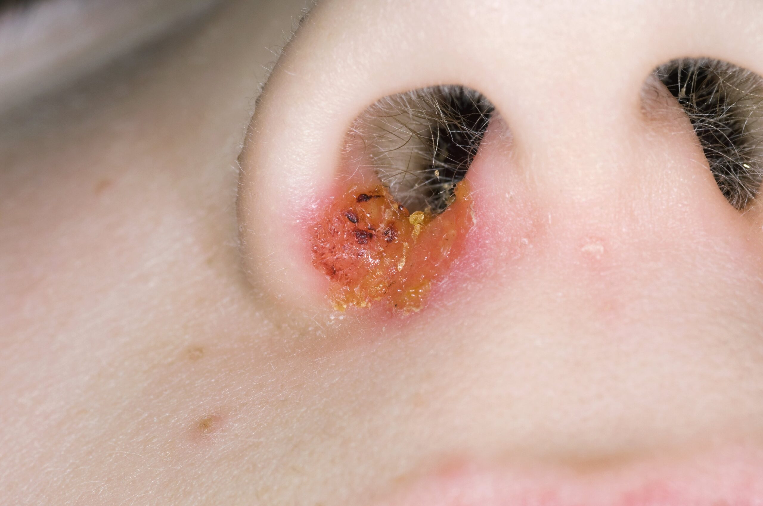 Impetigo krasta medene barve pod nosom