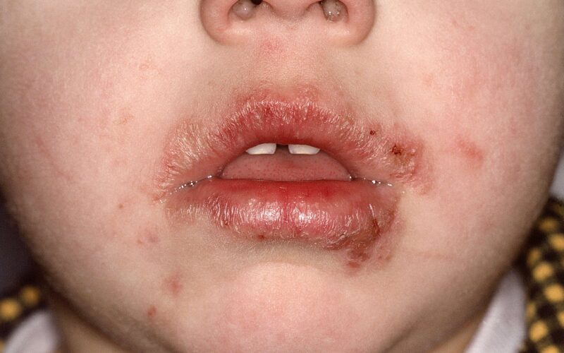 Impetigo lahko zdravimo doma. Veste s čim in kdaj je treba k zdravniku?