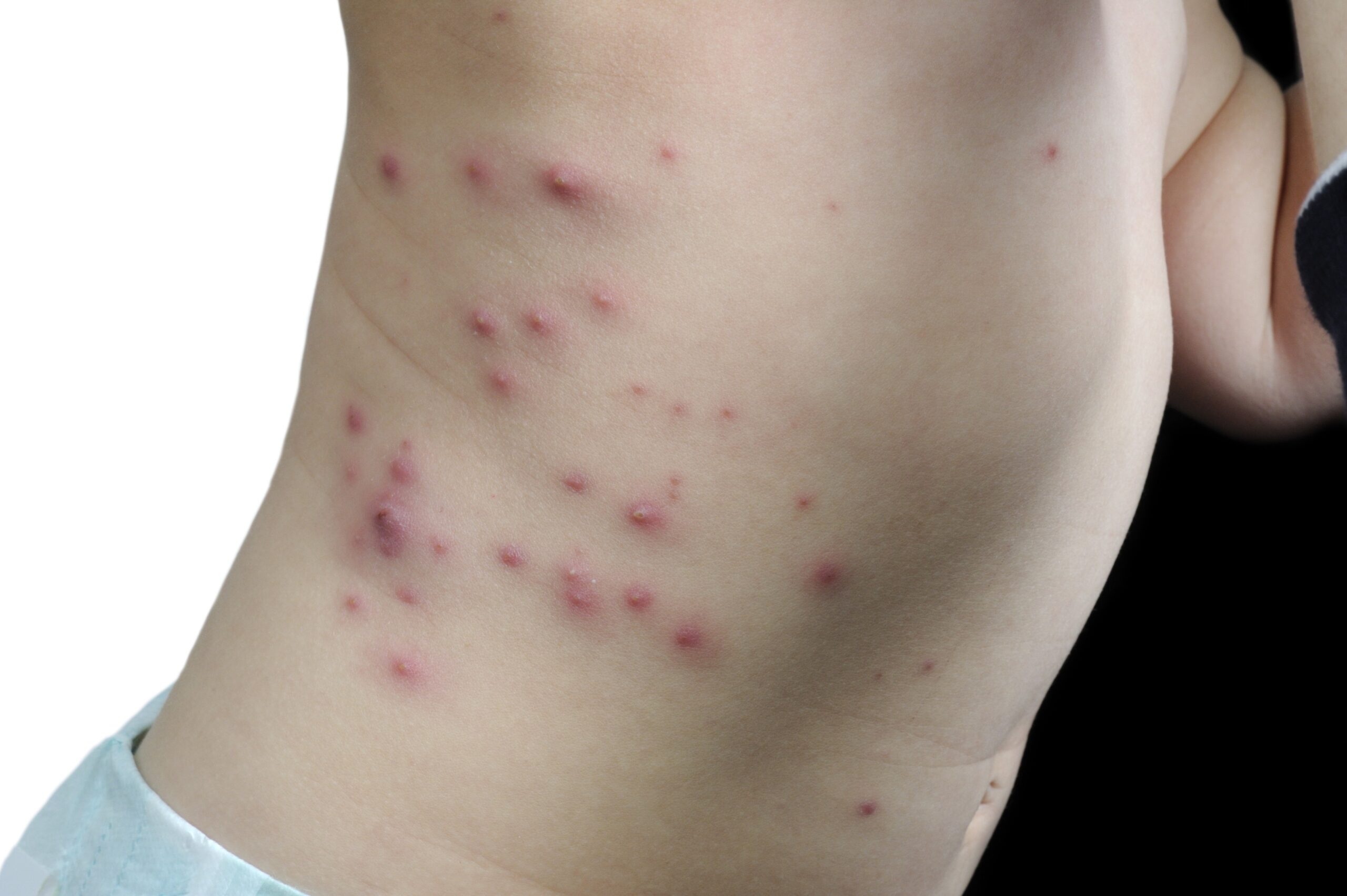 Impetigo papule (mehurčki)