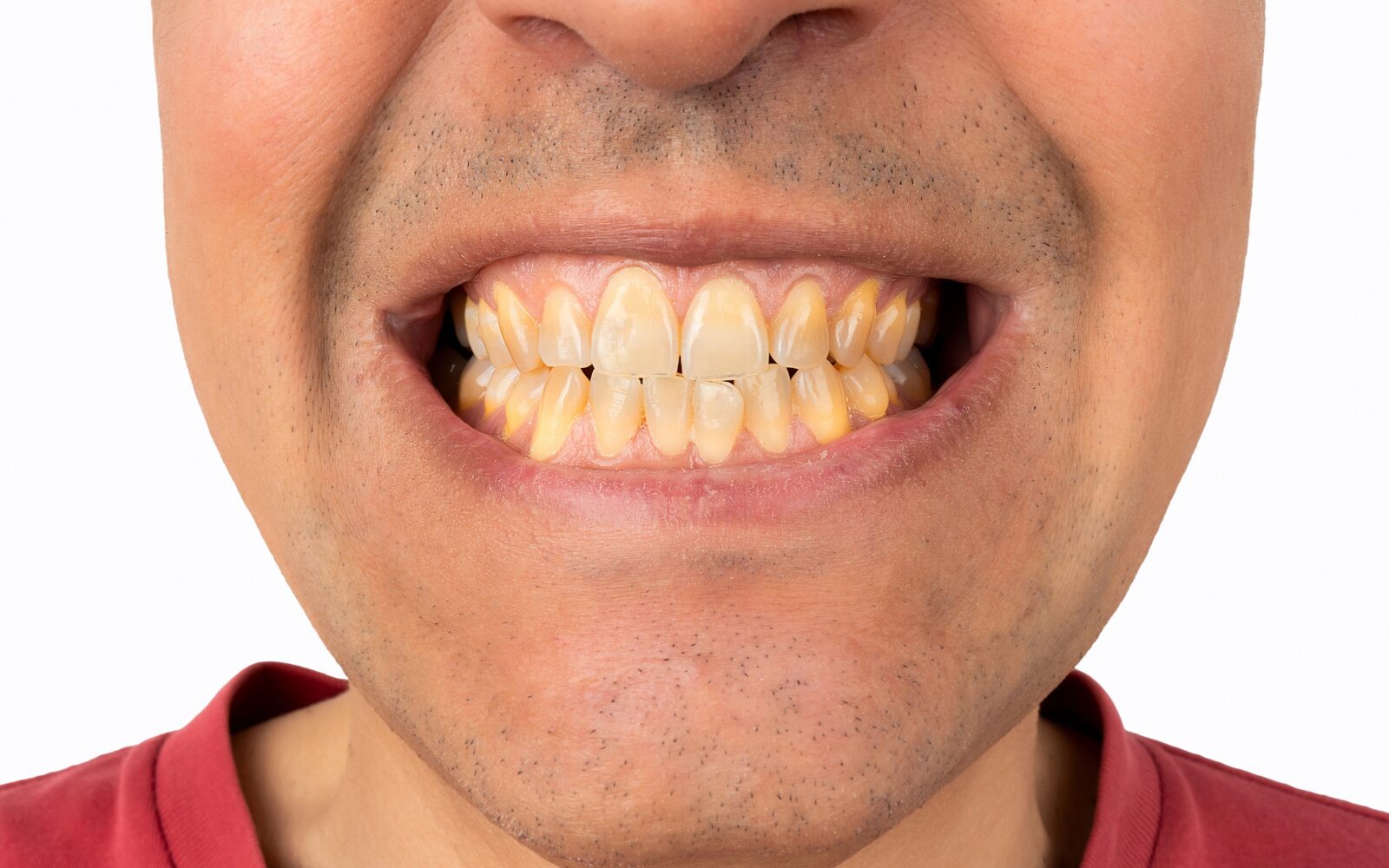 Portret moškega, ki ima rumene zobe zaradi kajenja in neustrezne prehrane.