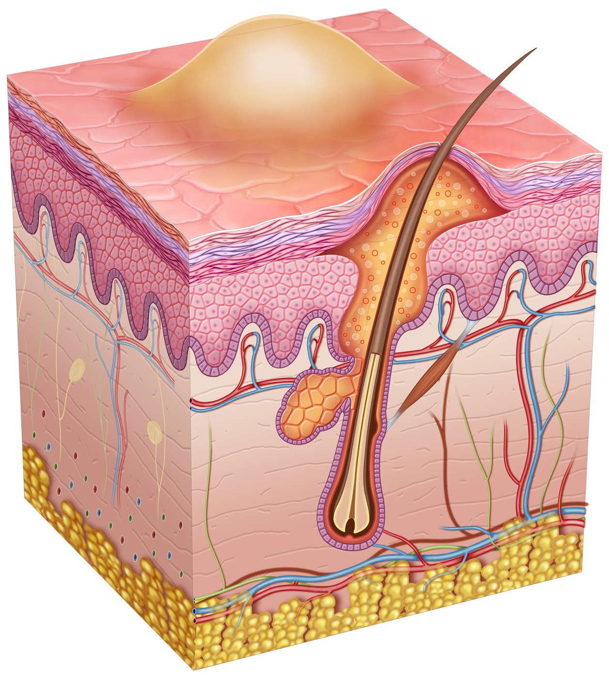 Medicinski prikaz vnetja kože zaradi vraščene dlake - folikulitis