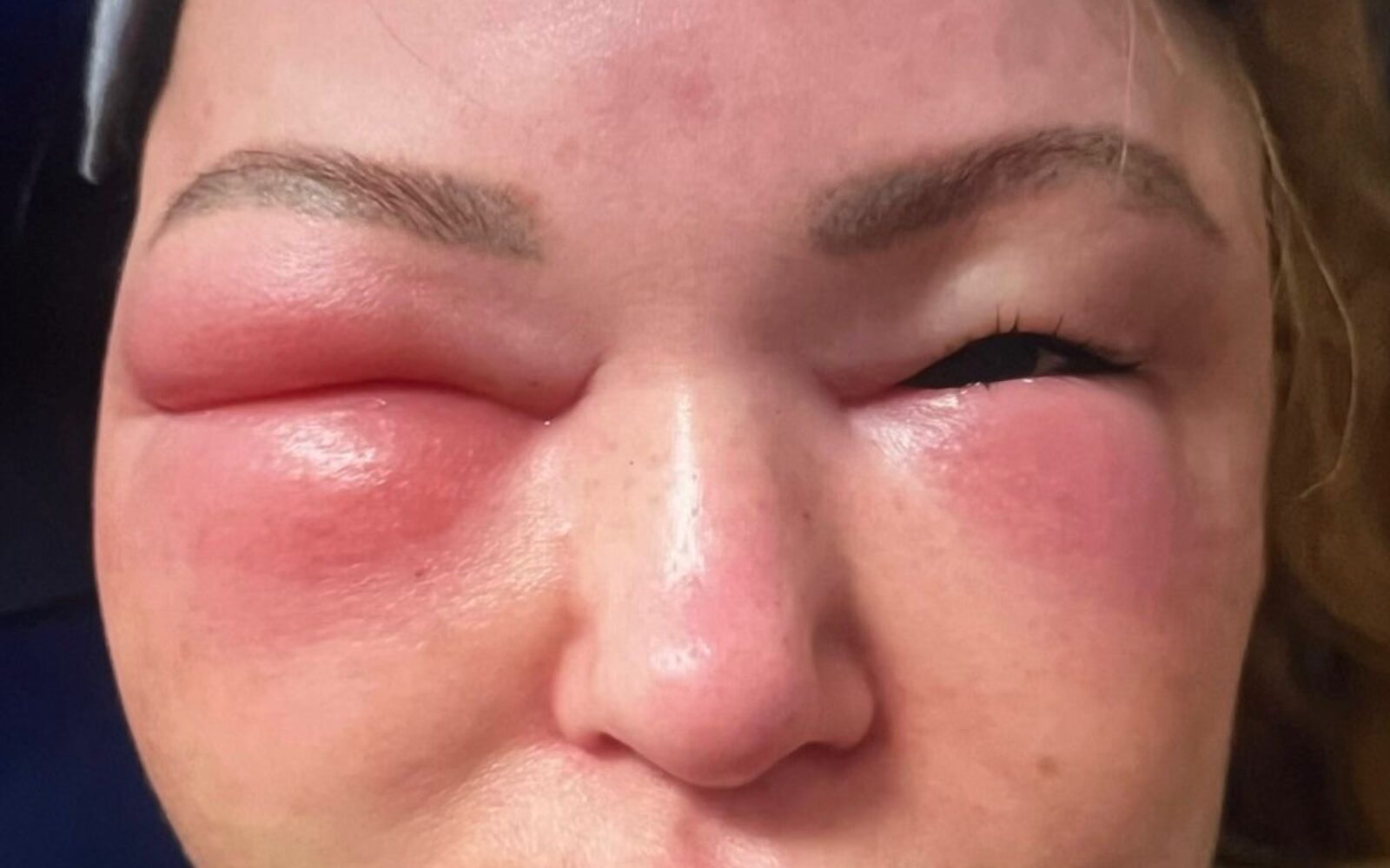 Claire Titterington, učiteljica športne vzgoje s hereditarnim angioedemom, ki povzroča hudo otekanje obraza, okončin in notranjih organov
