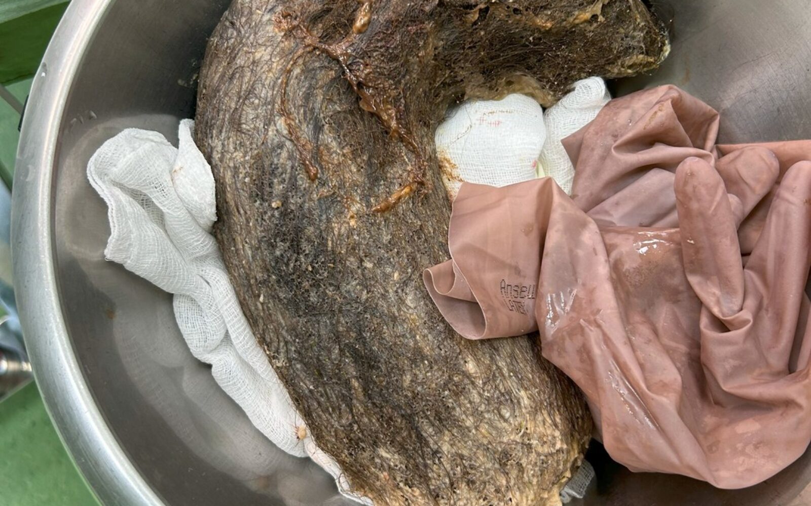 Trihobezoar oziroma velika kepa las, odstranjena iz želodca bolnice z Rapunzelinim sindromom